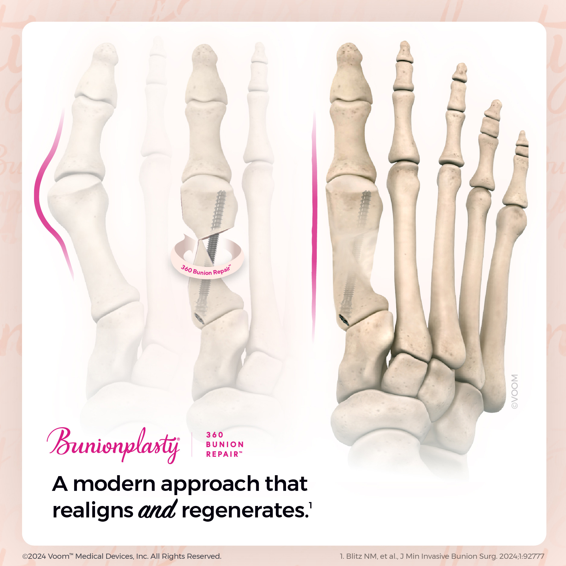 Bunionplasty_EducationGraphics_Alignment_01